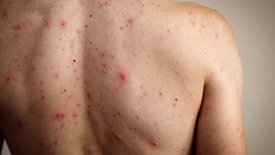 México es el segundo país con más muertes por sarampión a nivel mundial en 2025, advierte la OPS