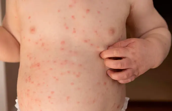 Fallece bebé por complicaciones asociadas al sarampión en Tlaxcala