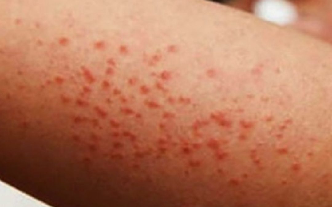 Cunde el Sarampión por todo el país, con 24 muertos. ¡Hay que vacunarse!