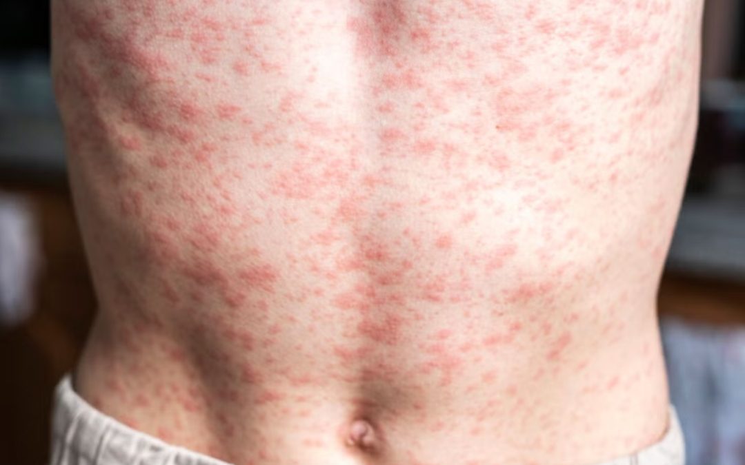 Brote de sarampión en México: Van 28 muertes y CDMX registra su primer deceso