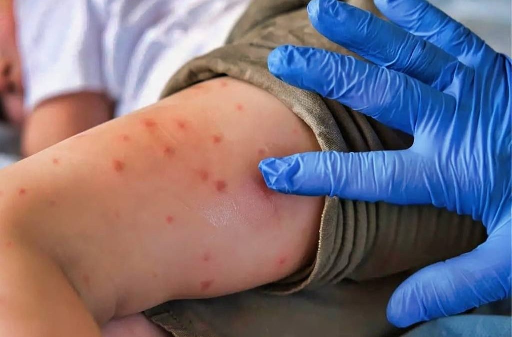 OPS emite alerta por sarampión en América; México concentra la mayor cantidad de casos