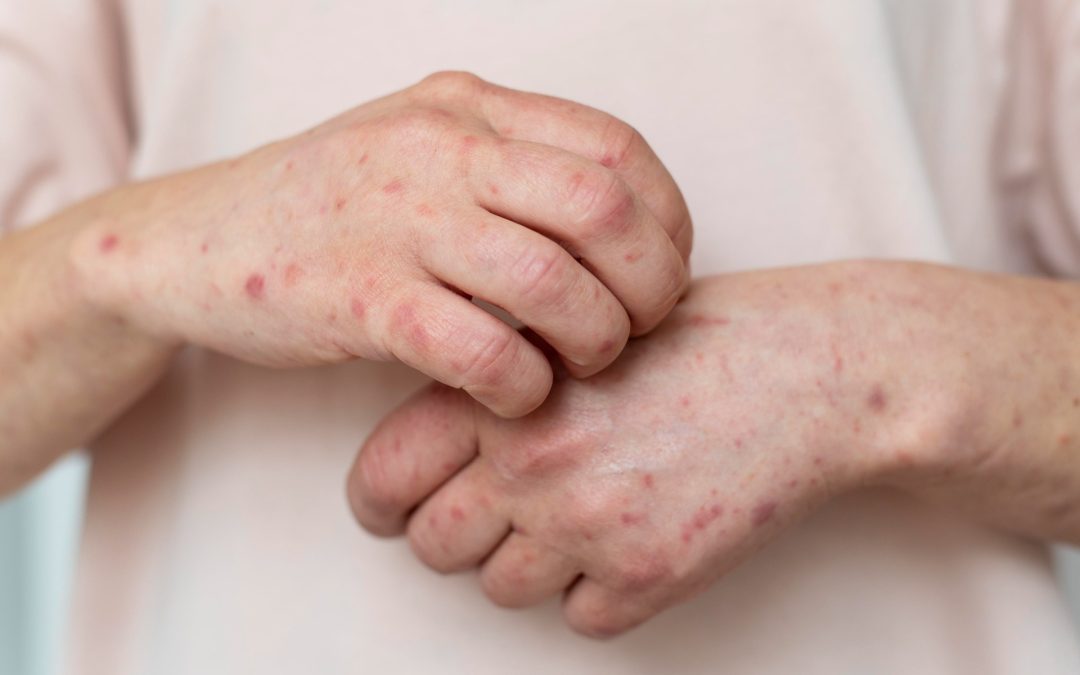 Brote de sarampión en México: Estados con más casos al 11 de febrero de 2026