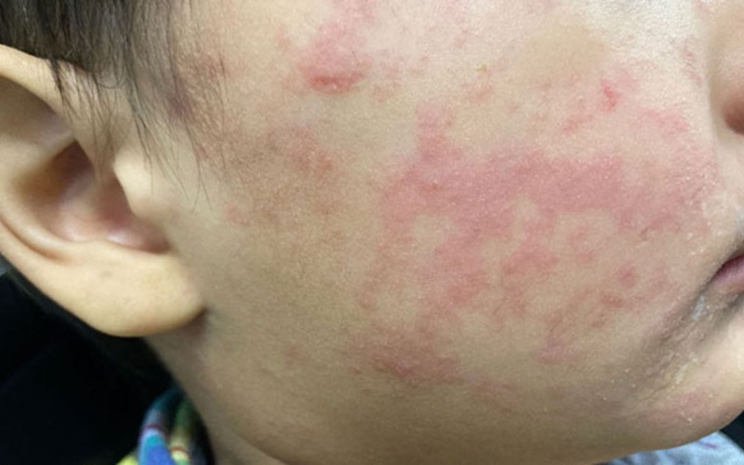 Sarampión supera los 2 mil casos en lo que va de 2026