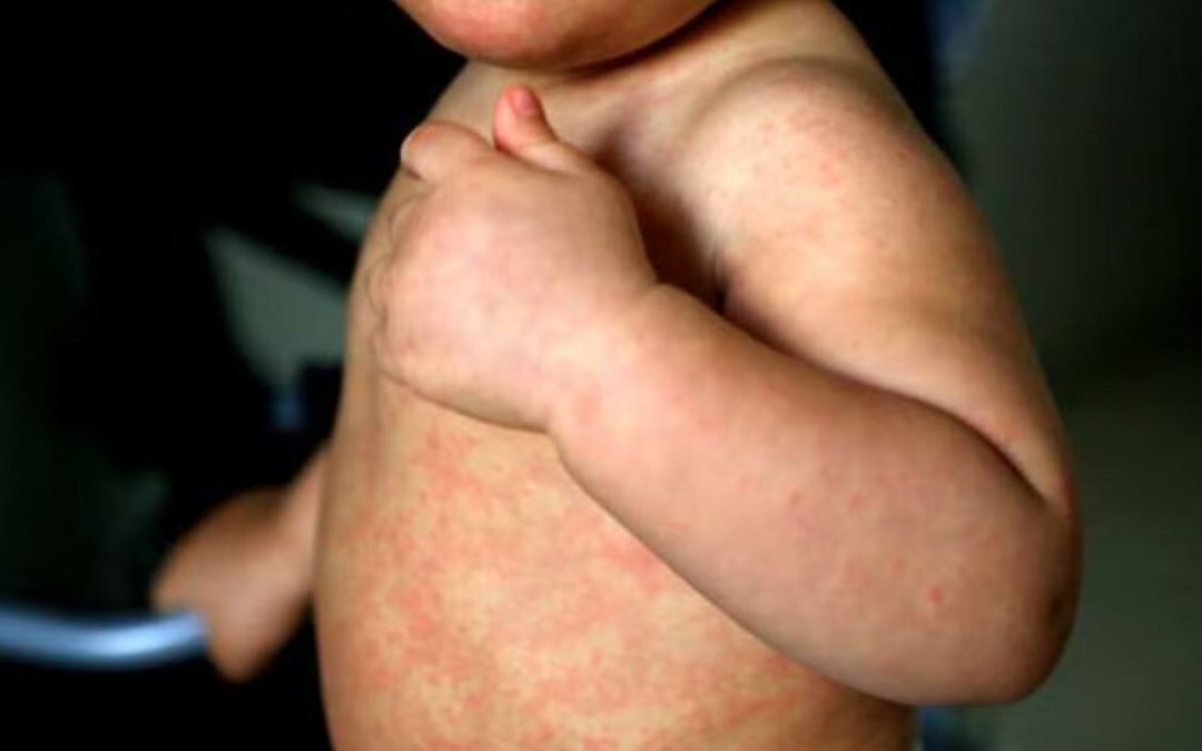 Vacunación masiva y ‘barridos’ en colonias: Así va la estrategia táctica de México para asfixiar el brote de sarampión