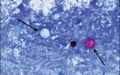 Alerta en EU por brote de Cyclospora: 2 mil personas sufren de ‘diarrea explosiva’