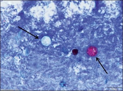 Alerta en EU por brote de Cyclospora: 2 mil personas sufren de ‘diarrea explosiva’