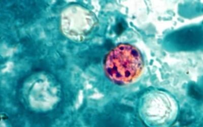México reporta tres casos de Cyclospora, ¿hay brote de la enfermedad?
